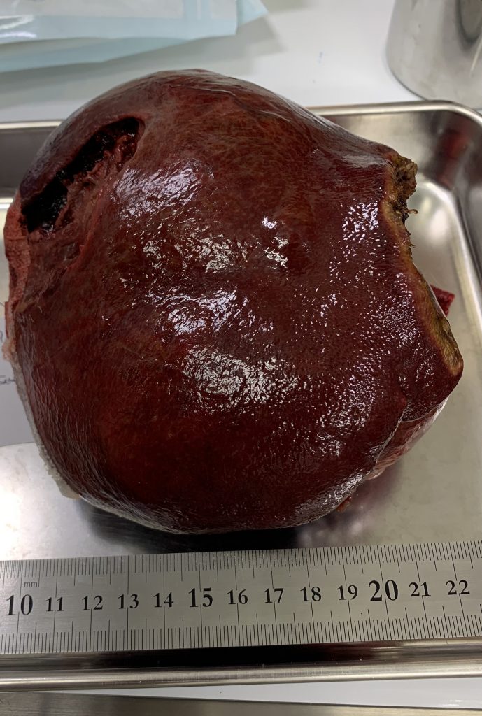 雑種犬の肝臓腫瘍摘出（肝細胞癌）