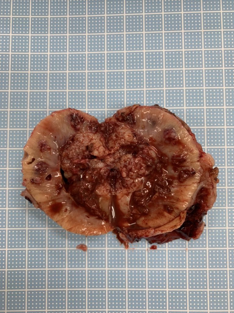 雑種猫の右腎に形成された肉腫（腎癌）